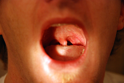 Patient with palate weakness on the right, and uvula deviation towards the left (source)