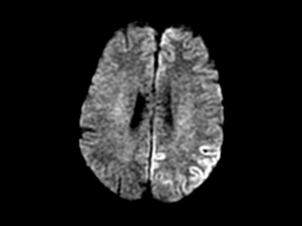Classic DWI MRI appearance of CJD showing hyper-intensity of affected regions (source)