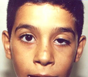 Left eye drooping (ptosis) seen in a patient (source)