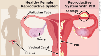 PID can comprise the integrity of the female reproductive system (source)