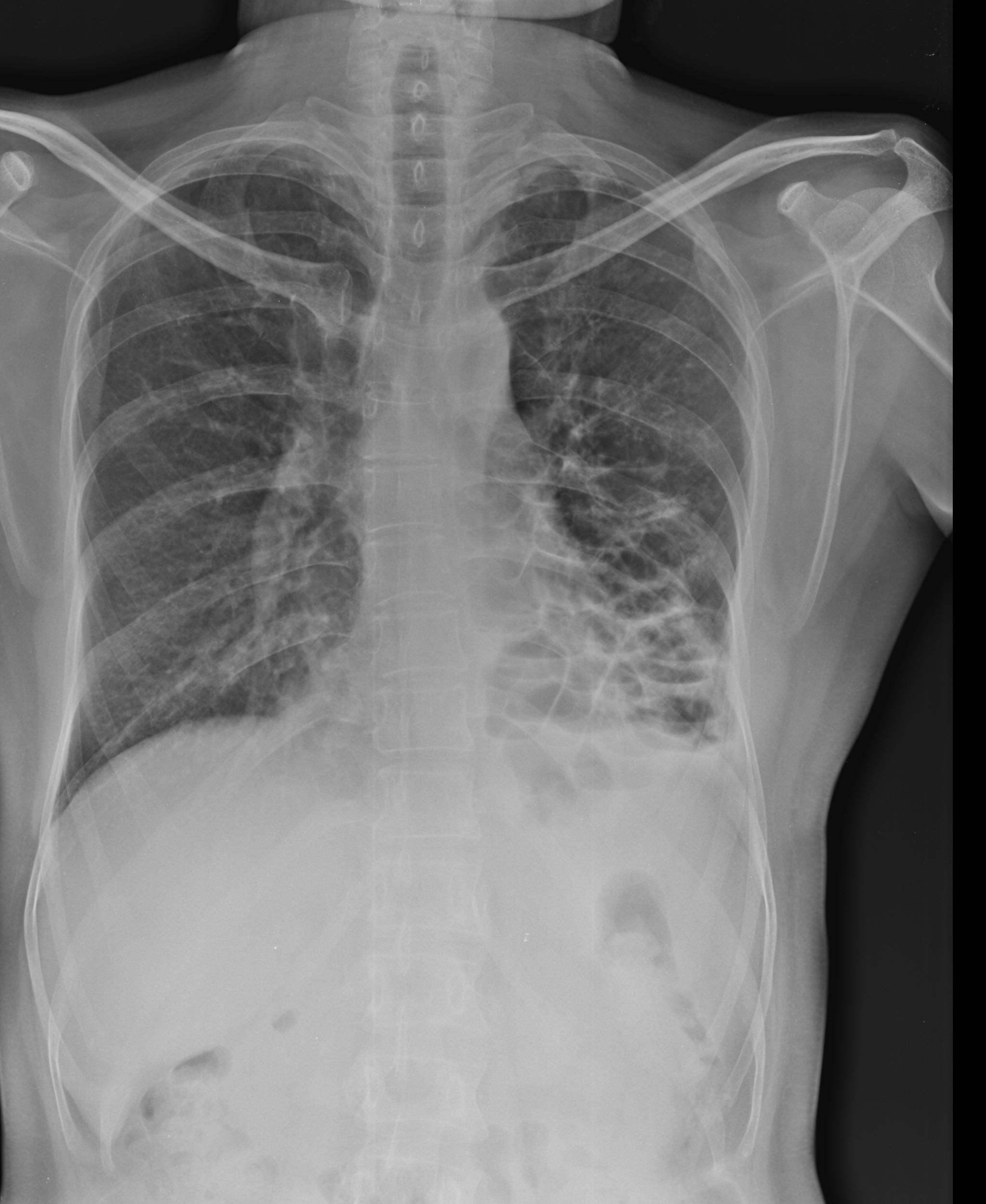 Chest x-ray for patient with bronchiectasis (source)