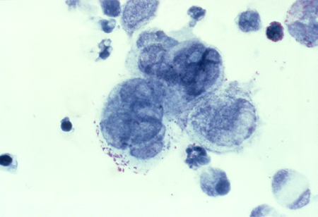 Tzank cells viewed histologically (source)