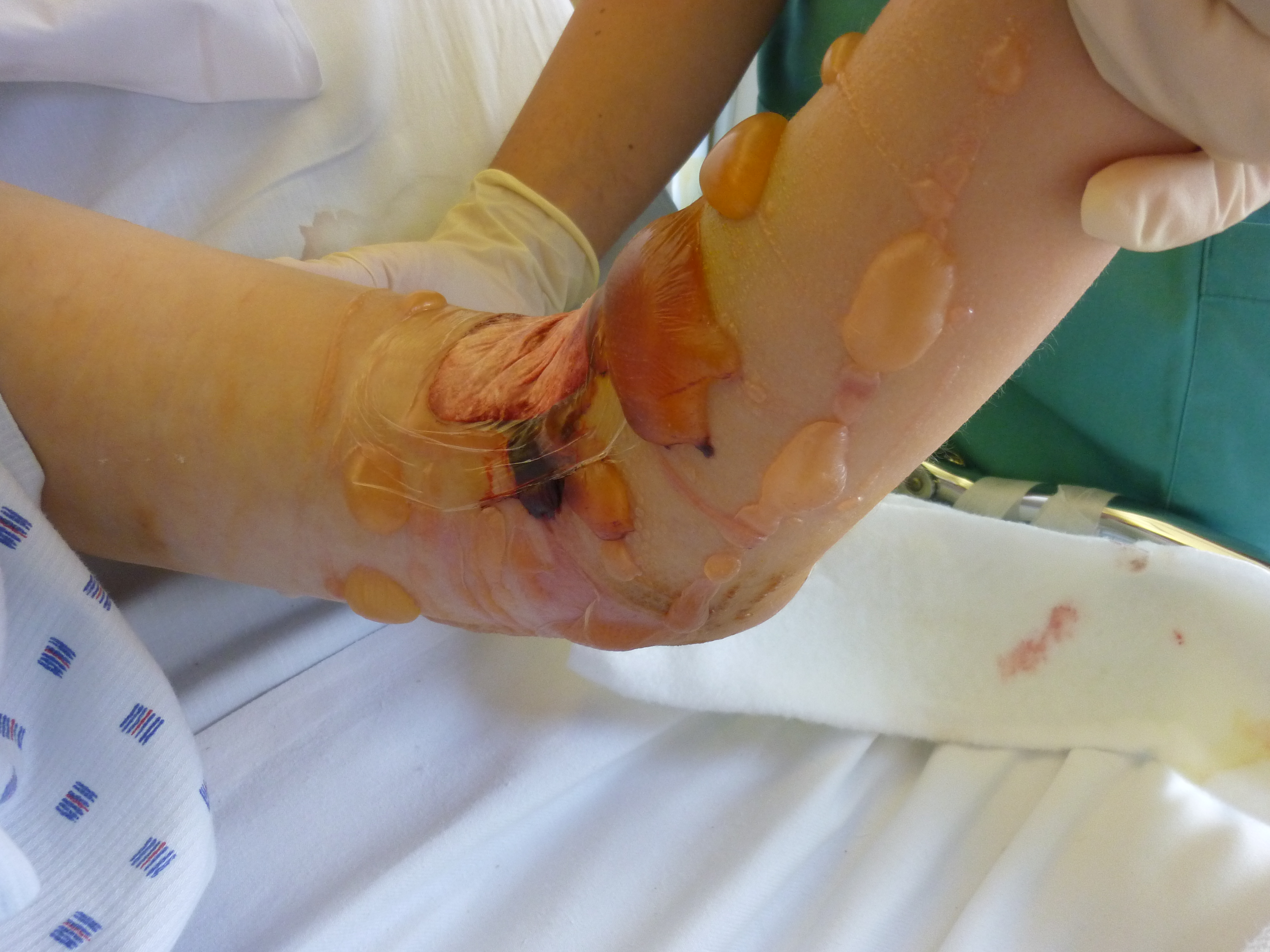 Acute compartment syndrome (source)
