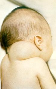 Cystic hygroma in newborn (source) 