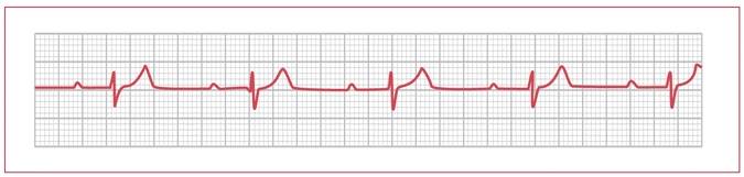 EKG of first degree heart block (source)