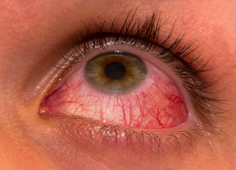 Uveitis (source)