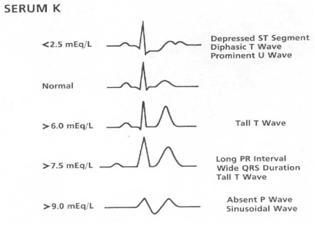 EKG findings at different serum concentrations of potassium (source)