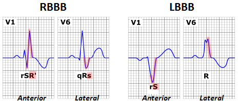 Right and left bundle branch block EKG findings (source)