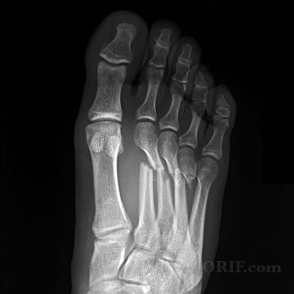 X-ray of metatarsal fractures (source)