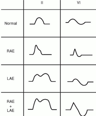P wave splitting EKG