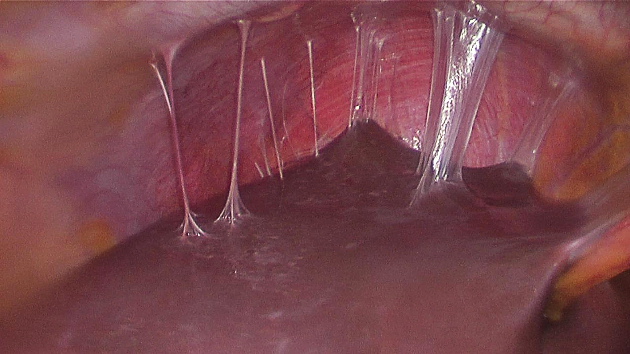 Violin string adhesions between liver and peritoneum (source)