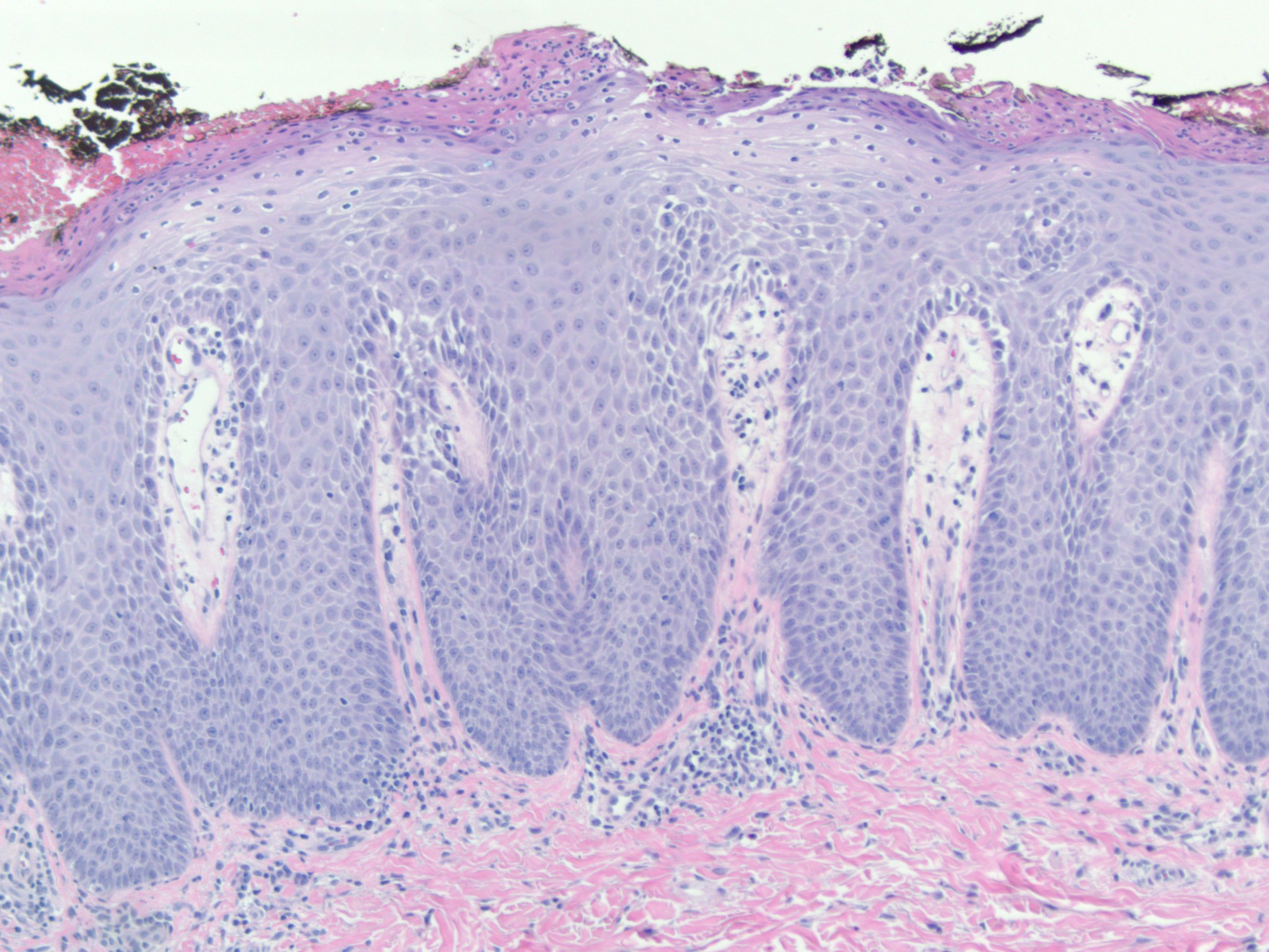 Biopsy of psoriasis showing a epidermal hyperplasia (source)