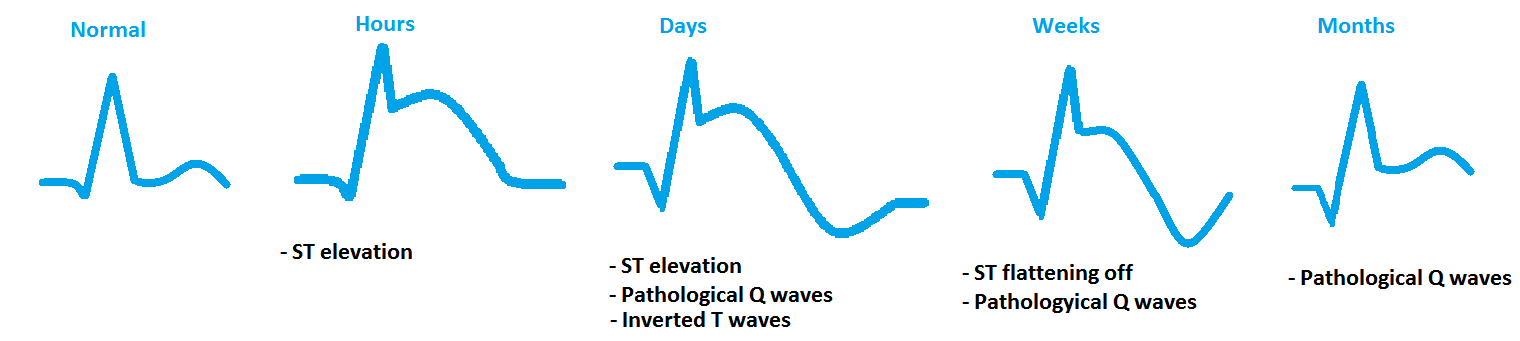 STEMI progression