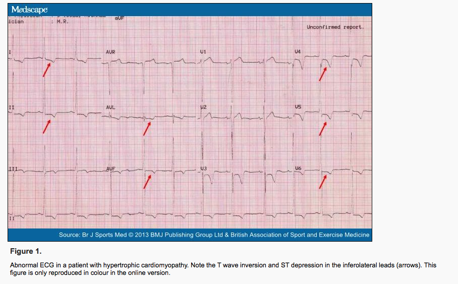 HCOM EKG