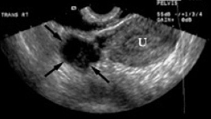 Ultrasound detection of turbo-ovarian abscess (source)