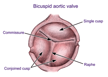 Bicuspid aortic valve (source)
