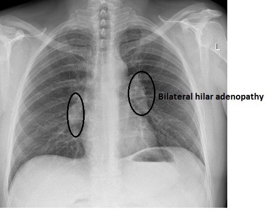 Bilateral hilar adenopathy (source)