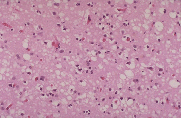 Histological analysis of CJD brain biopsy (source) 