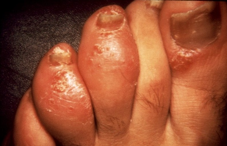 Dactylitis in the toes (source) 