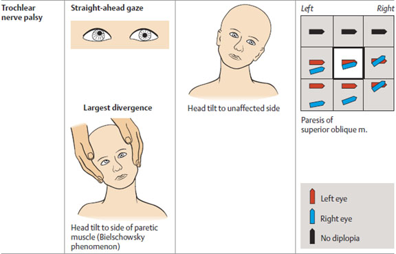Clinical presentation of trochlear nerve palsy (source)