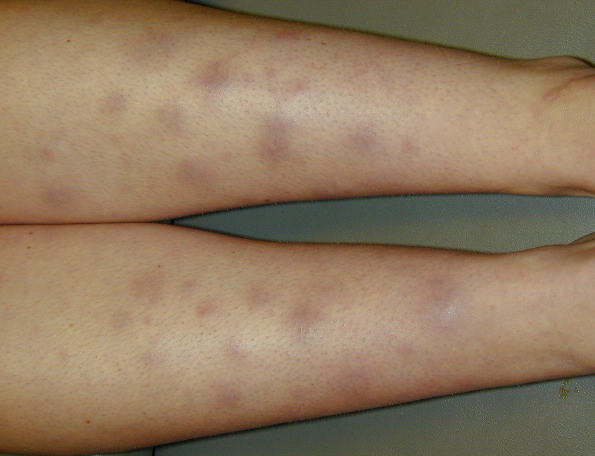 Erythema nodosum (source)