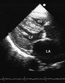 HCOM echocardiogram