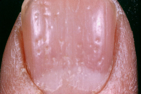 Pitting nail that can be found in psoriasis (source) 