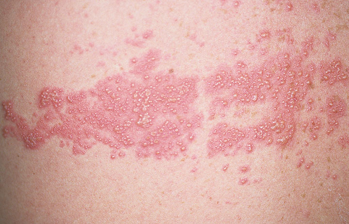 Dermatomal rash commonly found in shingles (source)