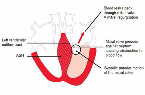 HCOM Murmur