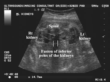 Ultrasound of a horseshoe kidney (source)