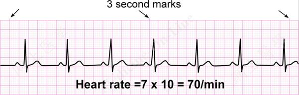 EKG 10 second strip