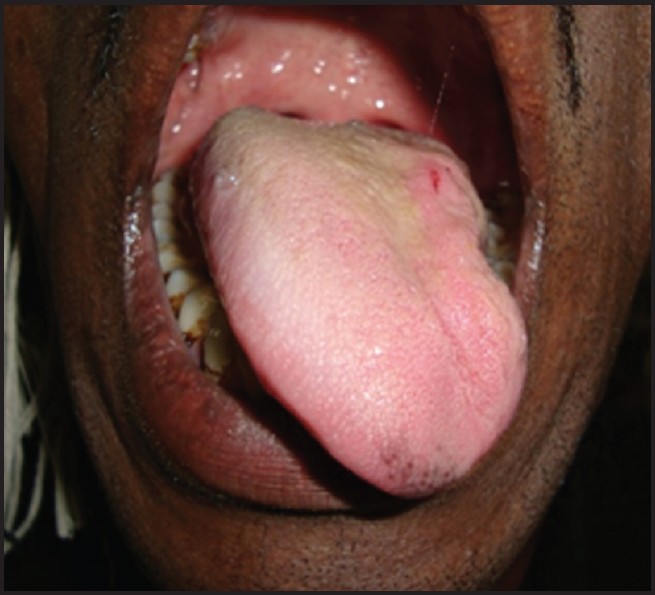 Tongue deviation towards the patient's left (source)