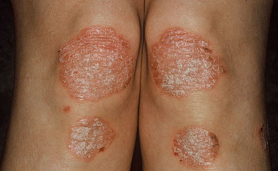 Psoriasis scales found on a patient's knees (source)