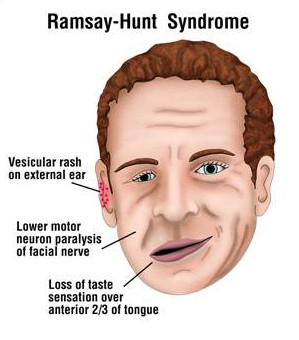 can herpes cause shingles