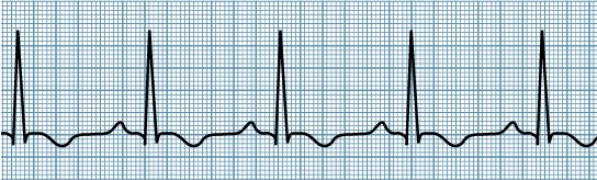 Inverted T waves (source )