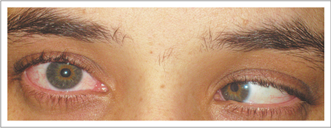 Right abducens nerve palsy (source)