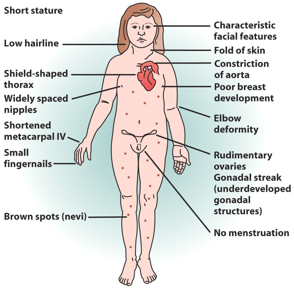Turner syndrome characteristics (source)