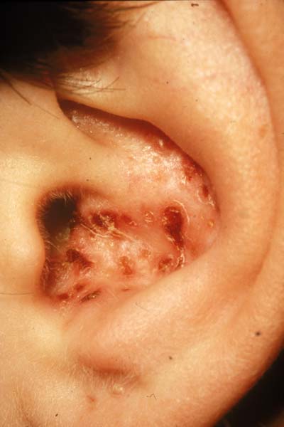 Clinical presentation of shingles on the outer ear of a patient (source)