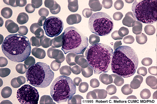 Inmature myeloid blasts seen in blood smear in patient with AML (source)