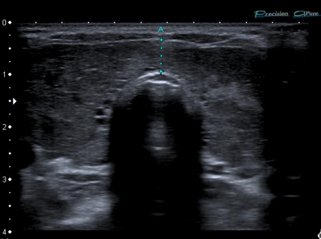 Diffusely large thyroid in Graves disease (seen by ultrasound, source)