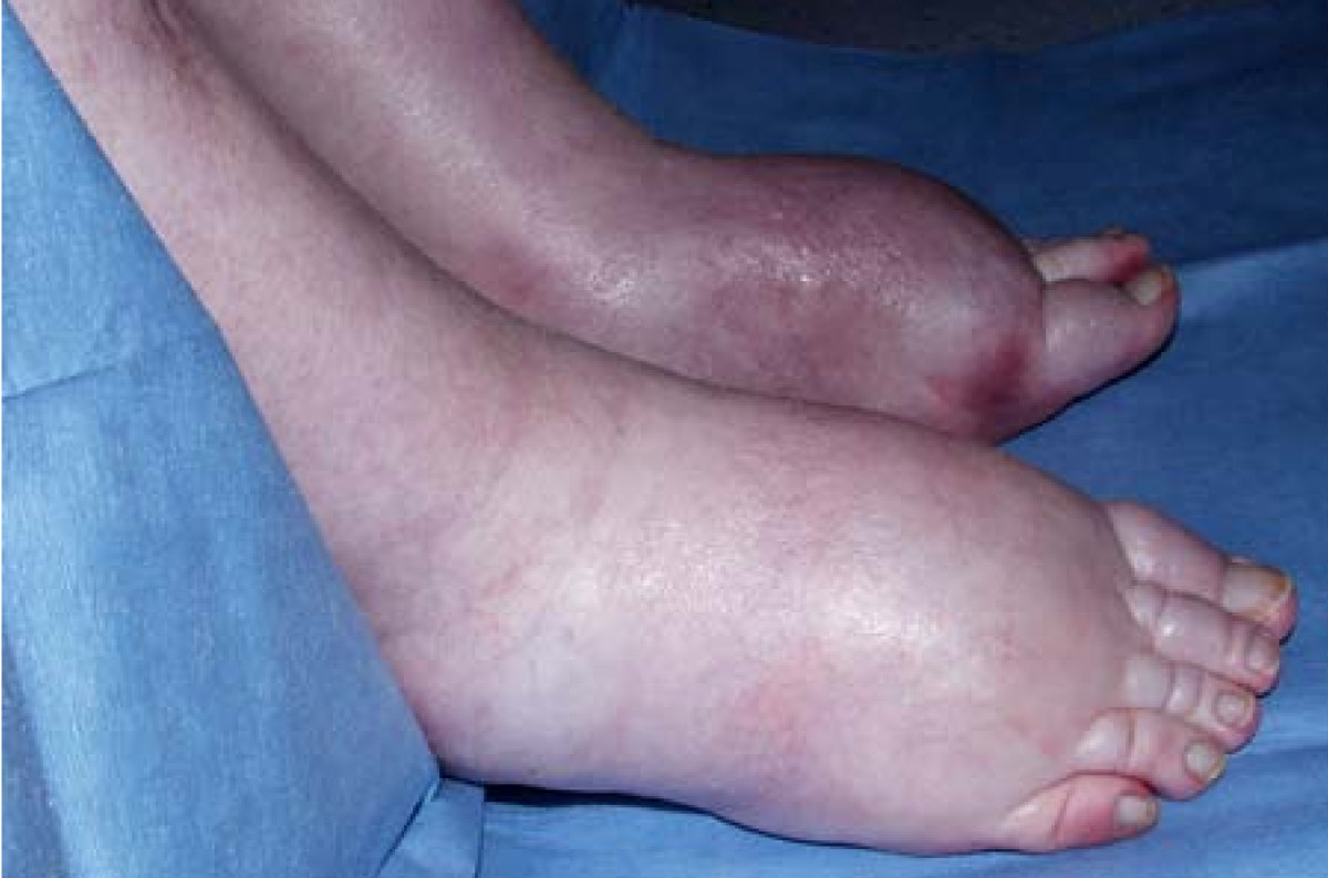 Clinical presentation of peripheral edema in the lower extremities (source)