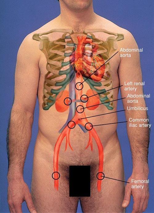 Locations to auscultate for bruits respective to specific arteries (source)