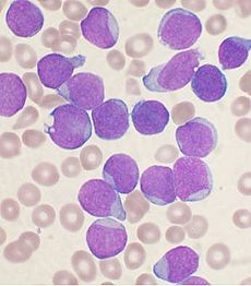 Blood smear of patient with ALL showing increased lymphoblasts (source)