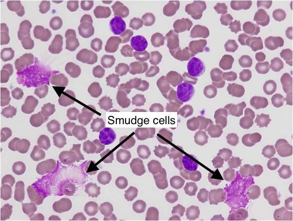 Smudge cells seen in a blood smear of a patient with CLL (source)