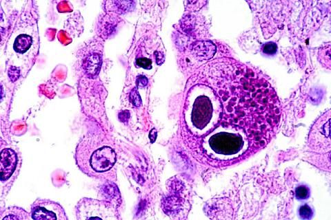 Reed-Sternberg cells seen in biopsy of patient with Hodgkin lymphoma (source)