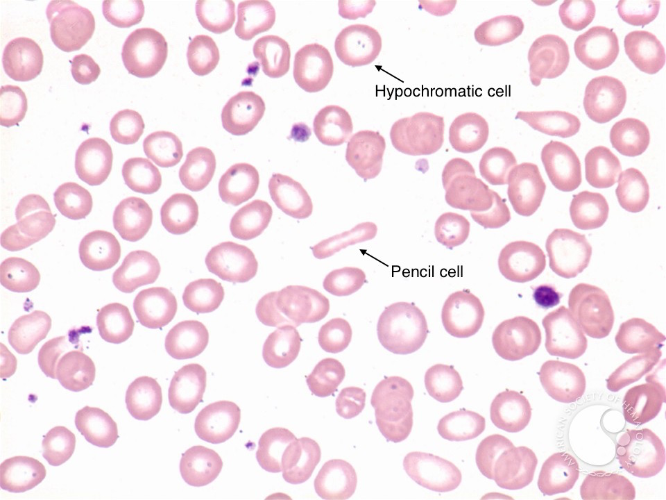 Hypocrhomatic and "pencil" RBCs seen on blood smear of patient with iron deficiency anemia (source)