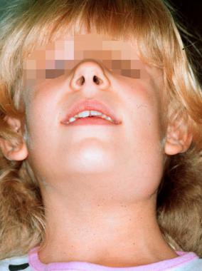 Physical manifestation of child with parotis (source)