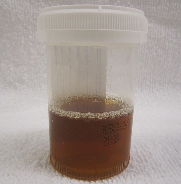 Coco-cola urine suggestive of hematuria (source)