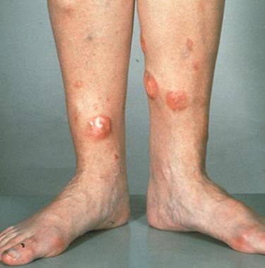 Tumerous leisions on the legs of a patient with DLBCL (source)