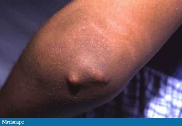 Subcutaneous nodules in rheumatic fever (source)